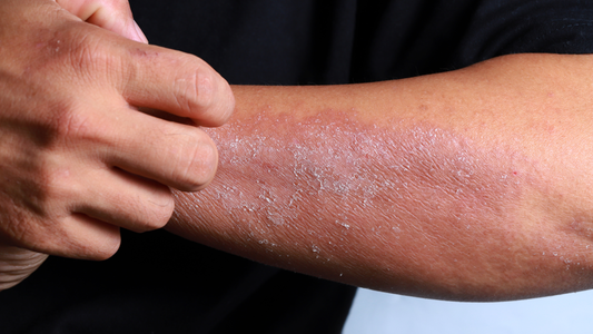 peau eczémateuse avant soin karité naturel